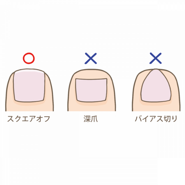 巻き爪 爪の切り方のポイント | 川口市の鍼灸・整体「明京堂治療院」