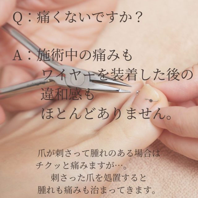 巻き爪Q&A